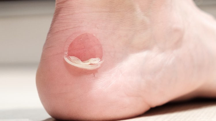 Do Anti-Blister Socks Work? Start With Fit and Friction