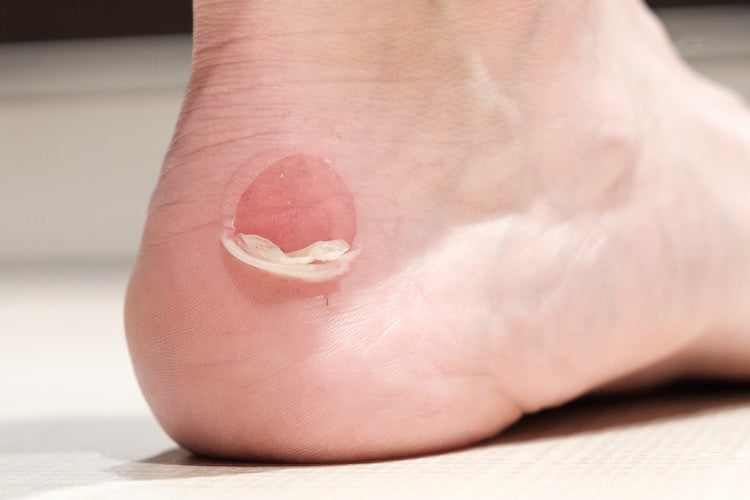 Do anti-blister socks work?  Running Injuries – Confluence Running Company