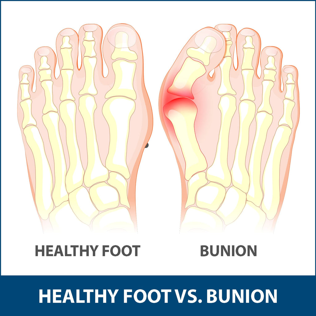 Bunions Explained